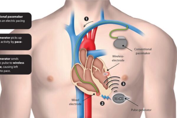 World’s first truly wireless pacemaker in trials