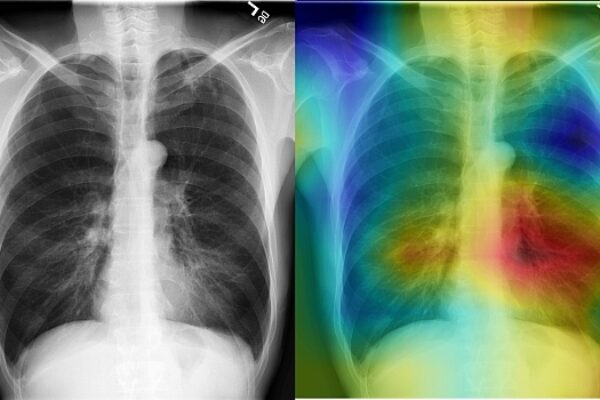 Algorithm beats radiologists in diagnosing x-rays