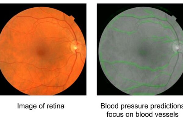 Google algorithm predicts cardiovascular risk from eye images