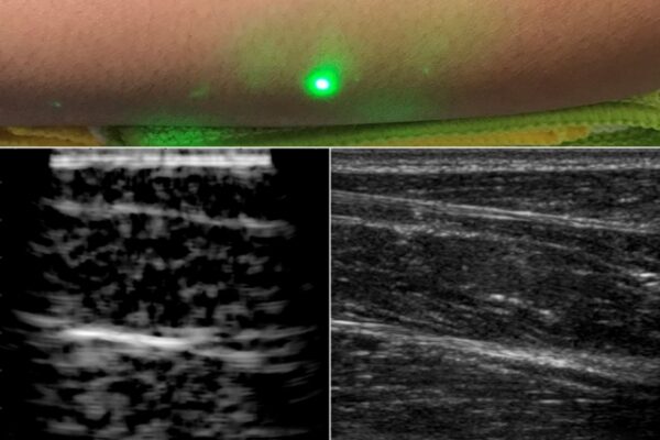 Laser ultrasound method achieves non-contact medical imaging